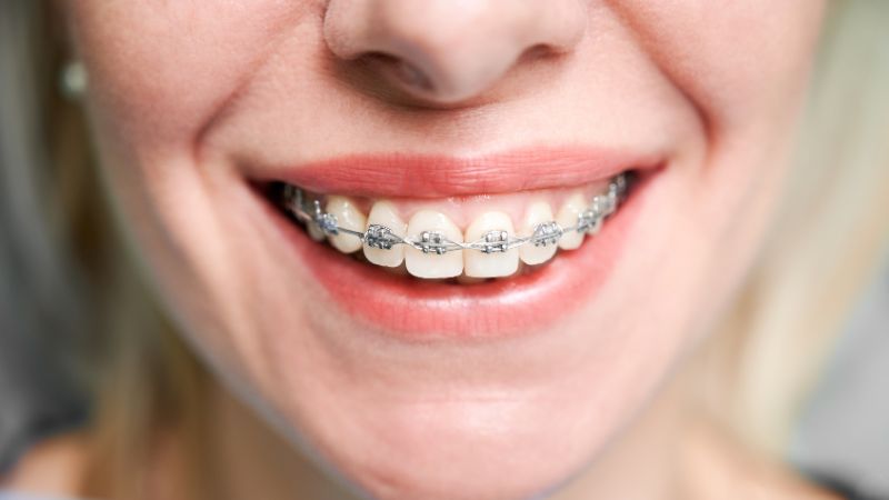 Metal braces or clear braces, which one is better?