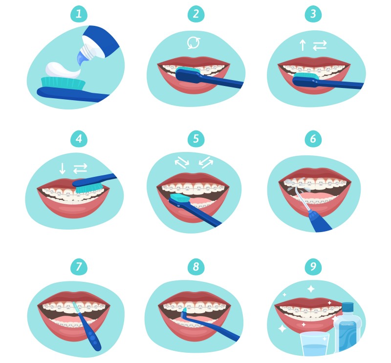 วิธีการรักษาสุขอนามัยช่องปาก สำหรับการจัดฟันเหล็ก