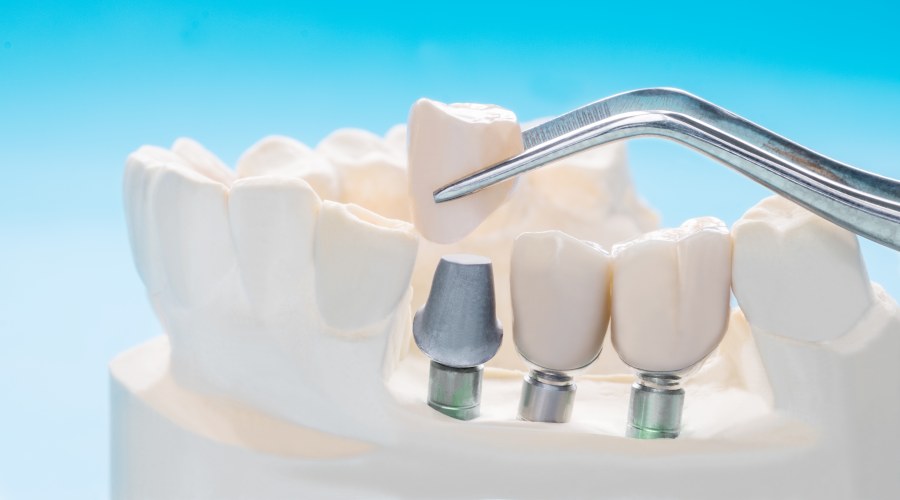 รากฟันเทียมทั้งปาก แบบติดแน่น ให้ฟันที่สูญเสียไปกลับใช้งานได้แบบปกติ