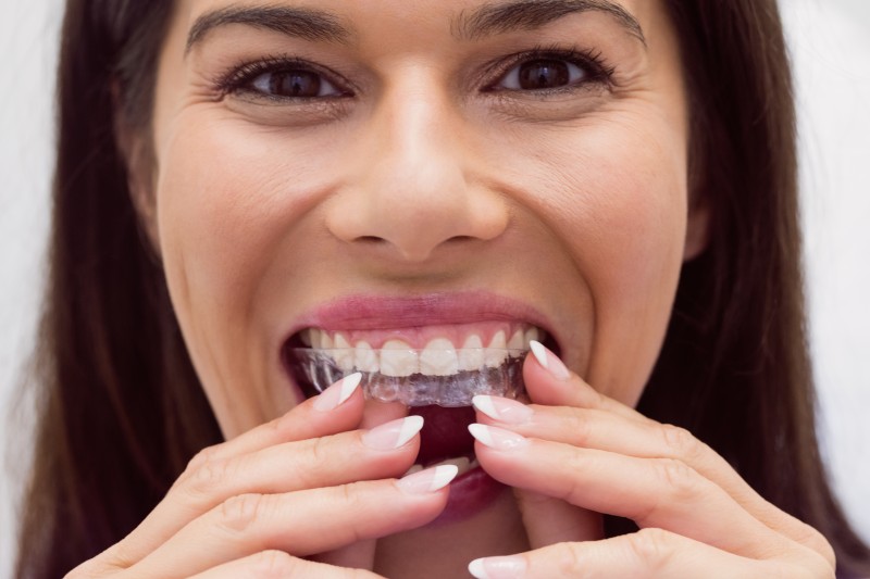 วิธีการรักษาสุขอนามัยช่องปาก สำหรับการจัดฟันใส