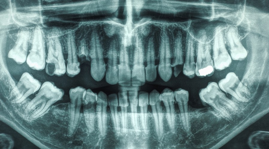 human-teeth-xray