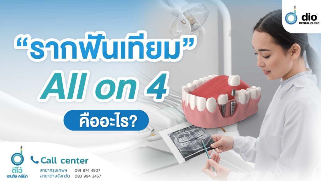 รากฟันเทียมทั้งปาก All on 4 คืออะไร