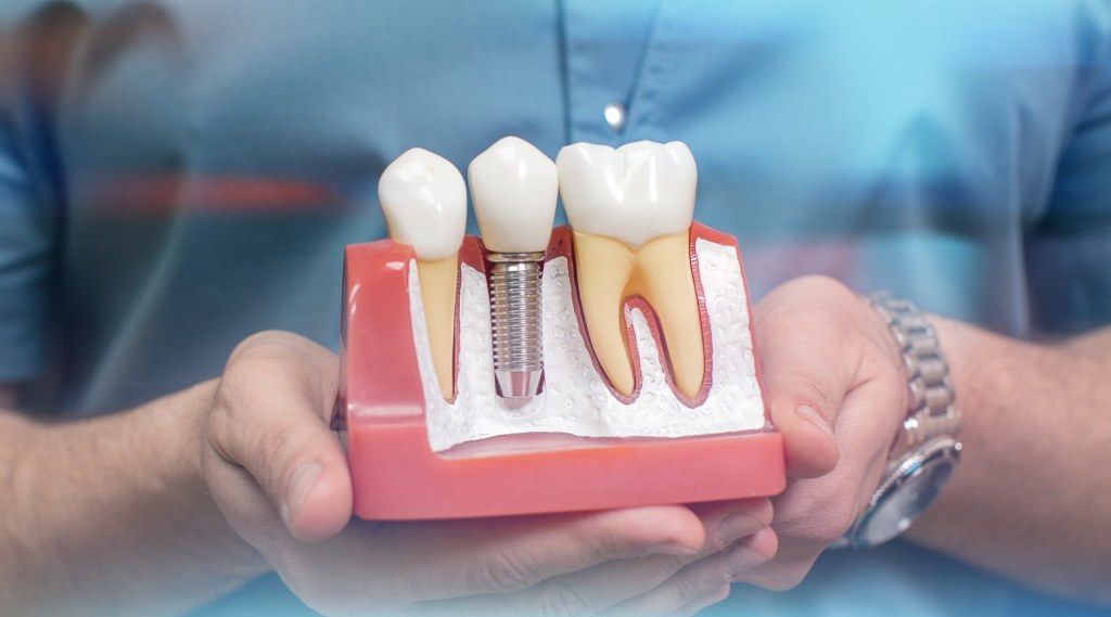 การปลูกรากฟันเทียมแบบทั่วไป ช่วยรักษาปัญหาฟันอะไรได้บ้าง มีวิธีการรักษาอย่างไร