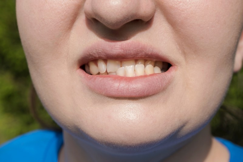 จัดฟันผ่าตัดขากรรไกร คืออะไร  แก้โครงหน้าและฟันที่ผิดปกติได้อย่างไรบ้าง ?