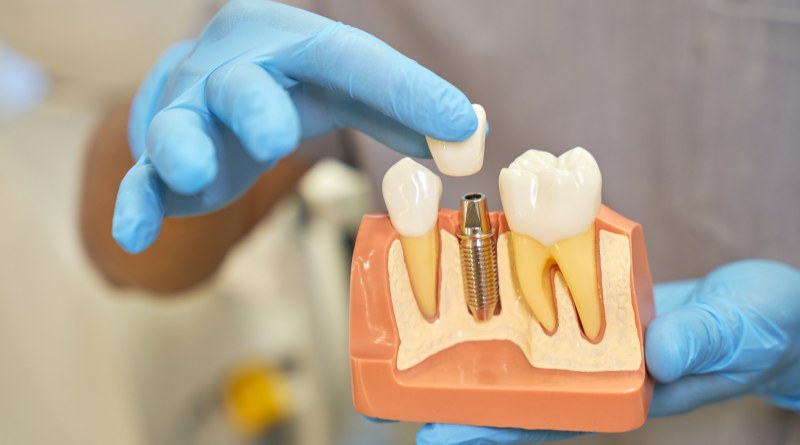 การปลูกรากฟันเทียมแบบทั่วไป ช่วยรักษาปัญหาฟันอะไรได้บ้าง มีวิธีการรักษาอย่างไร