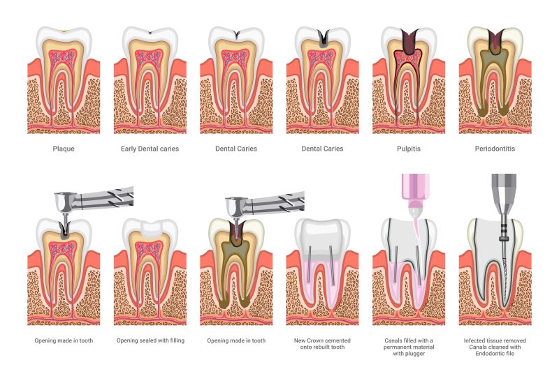 Collection_of_teeth_with_caries