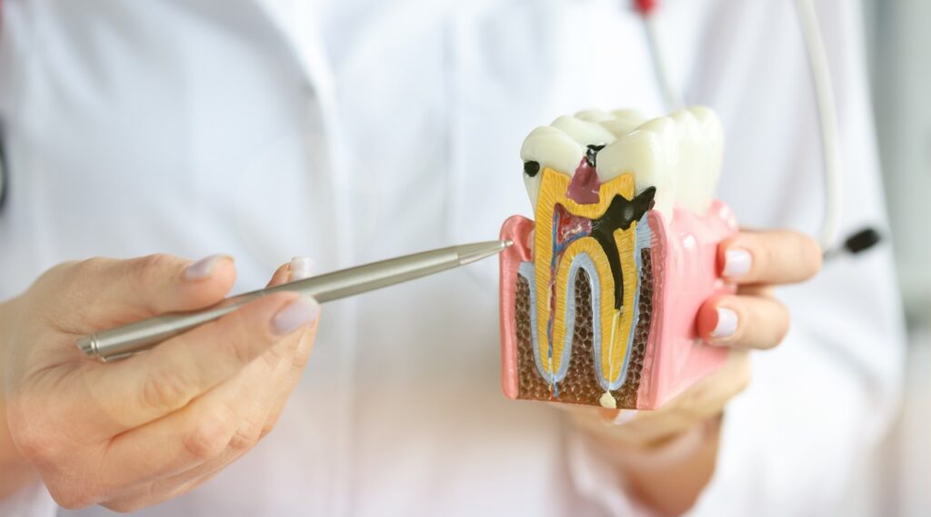 ฟันผุเยอะ ๆ ทำไมถึงควรรักษารากฟัน มากว่าอุดฟัน