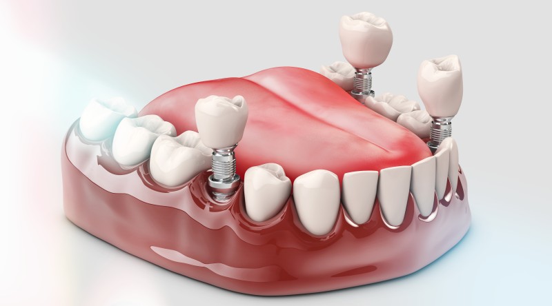 รากฟันเทียม (Dental implants)