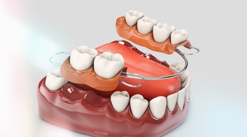 ฟันปลอมบางส่วน (partial denture)