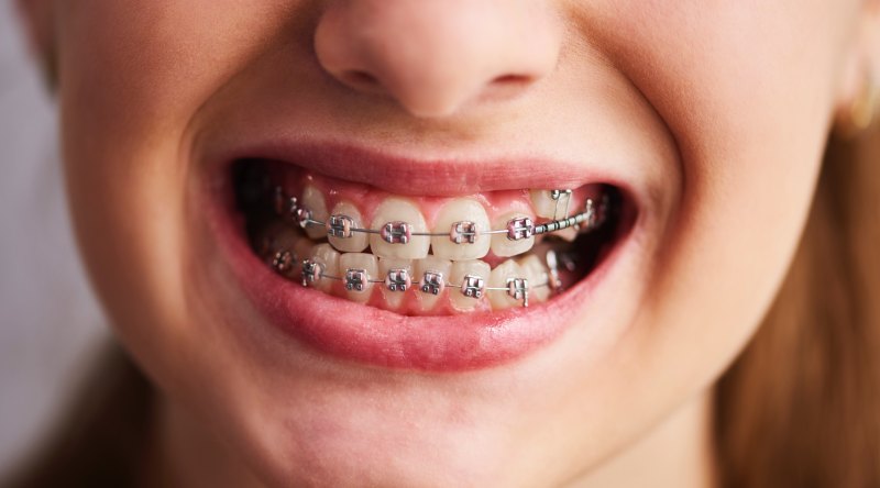 shot-teeth-with-braces (3)