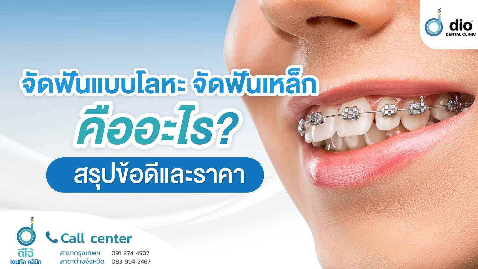 จัดฟันแบบโลหะ จัดฟันเหล็ก คืออะไร สรุป ข้อดีและราคา