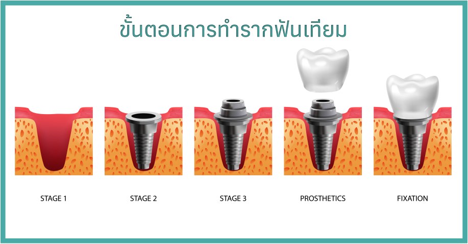 ขั้นตอนการทำรากฟันเทียม