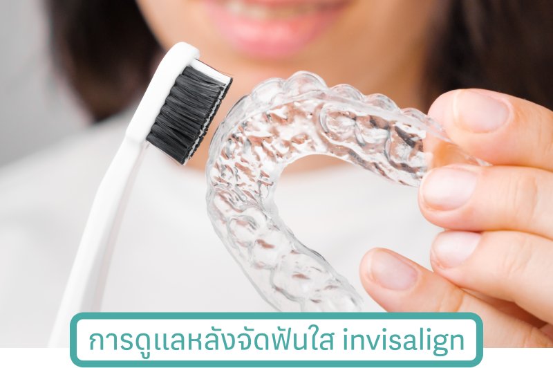 การดูแลหลังจัดฟันแบบใส invisalign