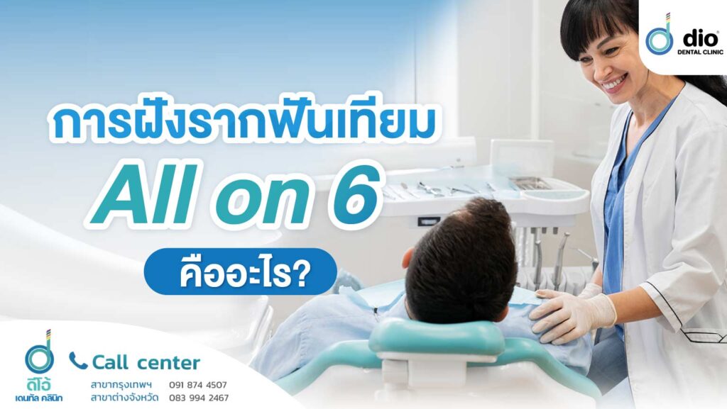 การฝังรากฟันเทียม All on 6 คืออะไร