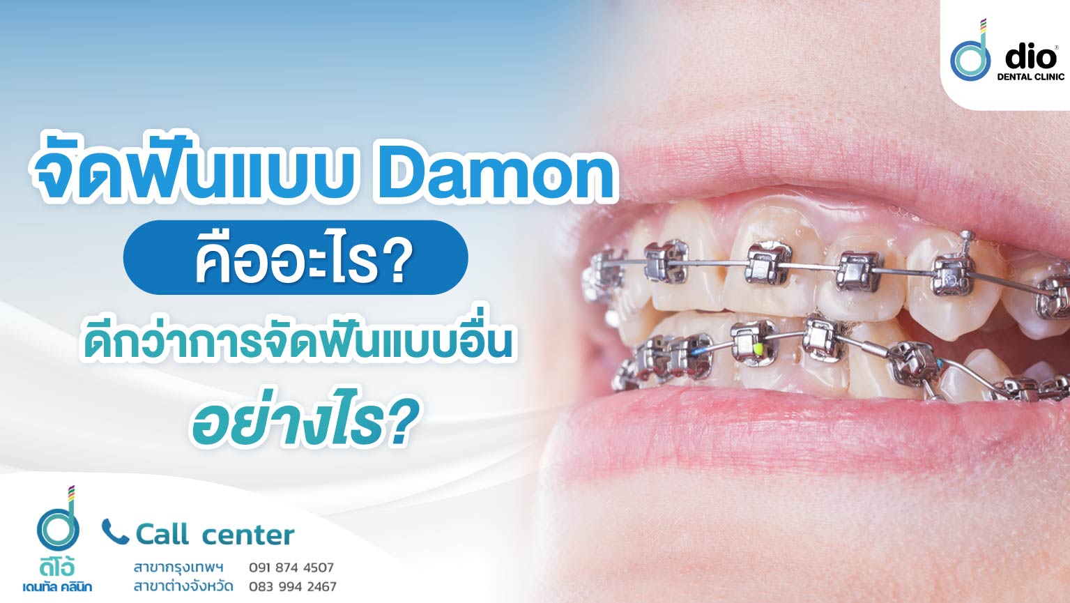 จัดฟันแบบ-Demon-คืออะไร--ดีกว่าการจัดฟันแบบอื่น-อย่างไร-