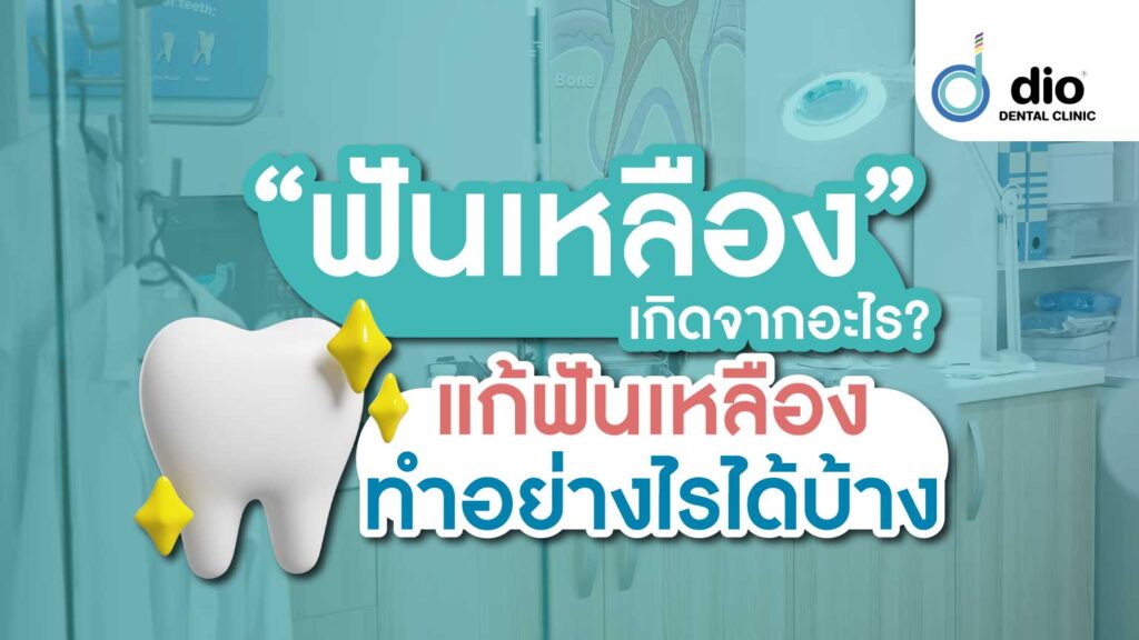 ฟันเหลืองเกิดจากอะไร แก้ฟันเหลืองทำอย่างไรได้บ้าง