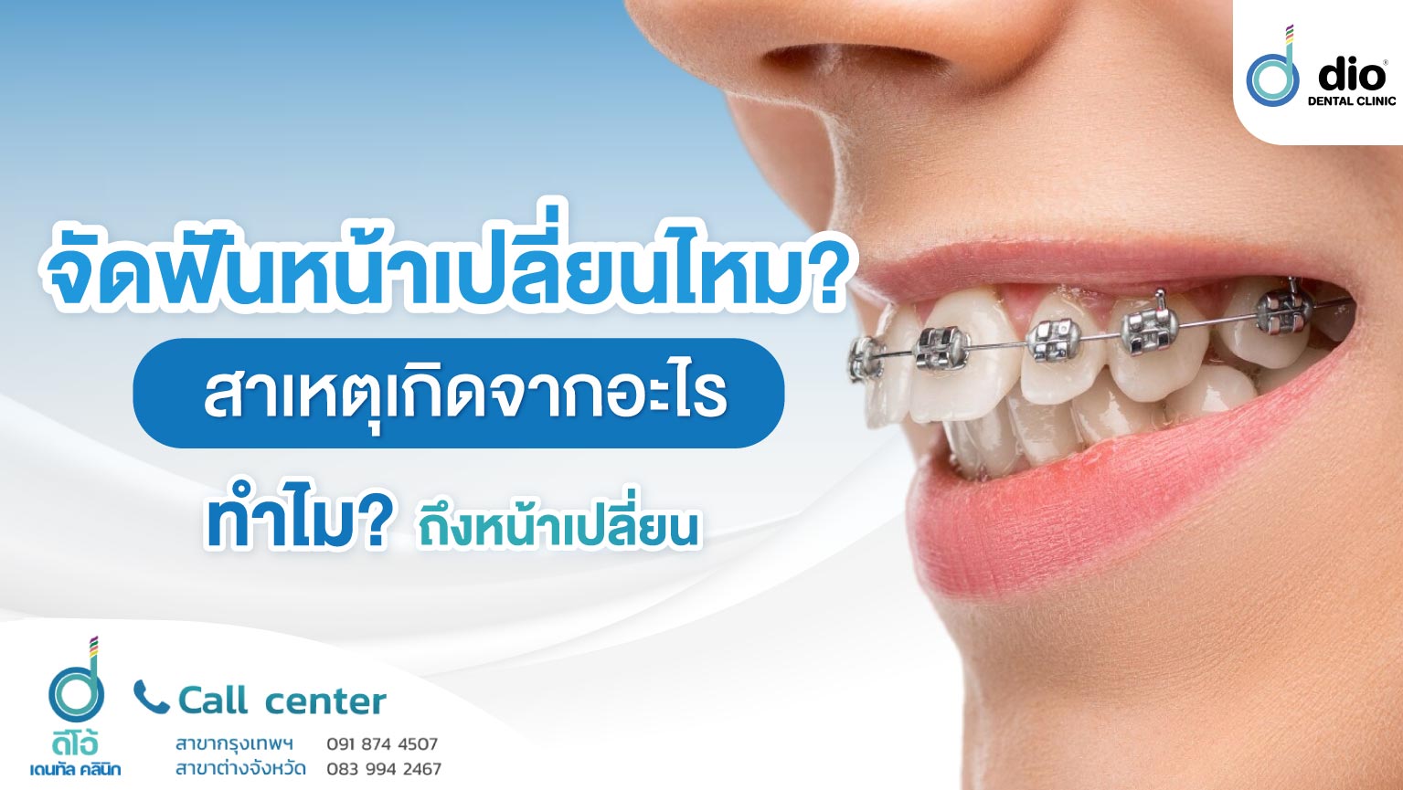 จัดฟันหน้าเปลี่ยนจริงไหม สาเหตุเกิดจากอะไร ทำไมถึงหน้าเปลี่ยน