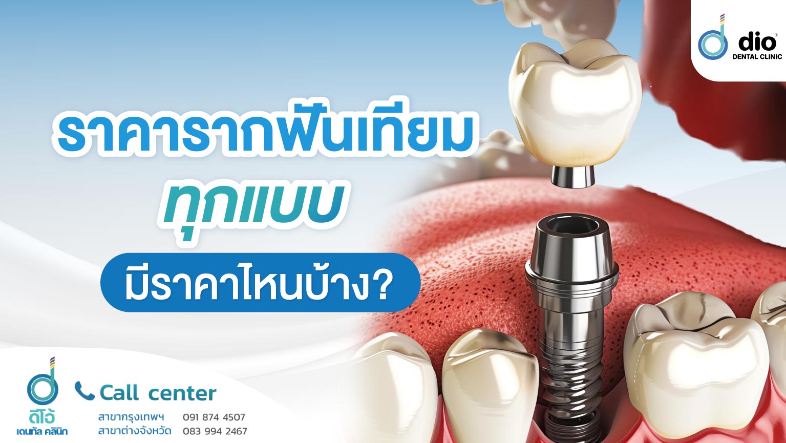 ทำรากฟันเทียมแพงหรือไม่ มีราคาไหนบ้าง