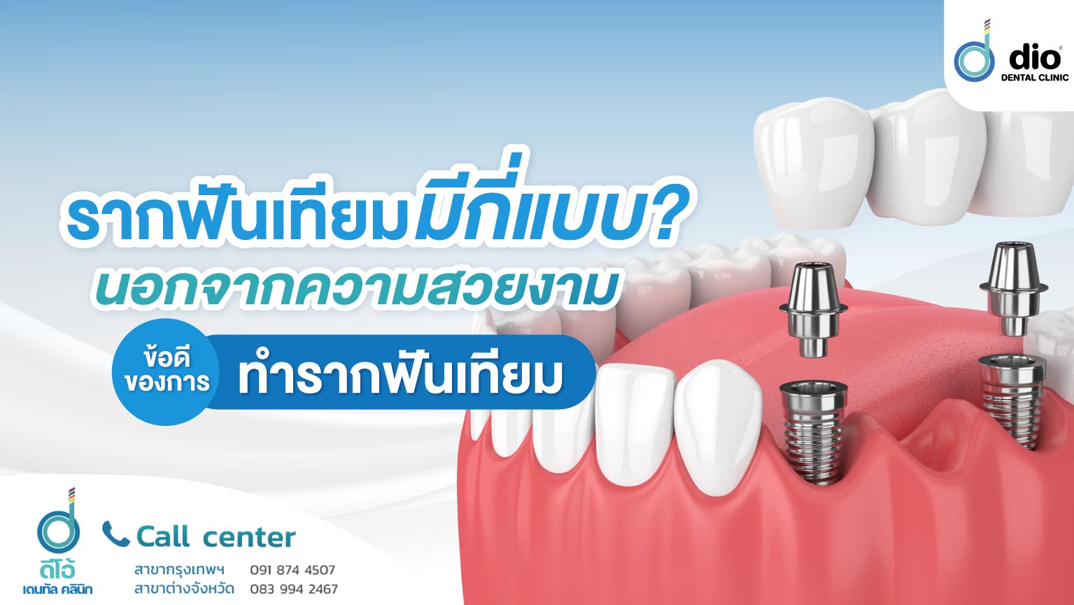 รากฟันเทียมมีกี่แบบ ข้อดีของการทำรากฟันเทียม