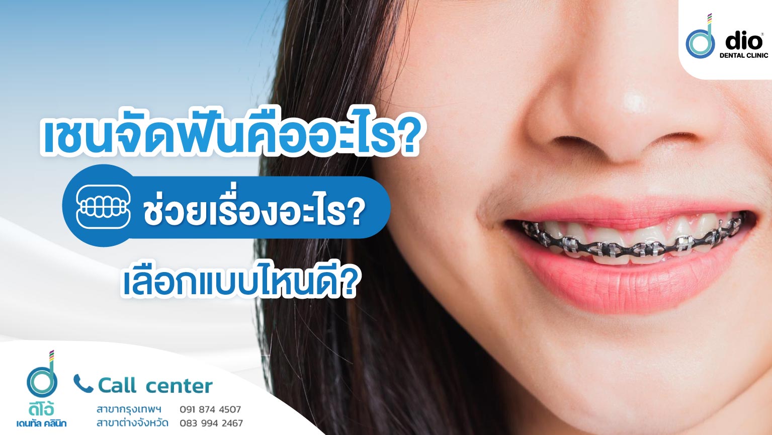 เชนจัดฟันคืออะไร ช่วยเรื่องอะไร เลือกแบบไหนดี