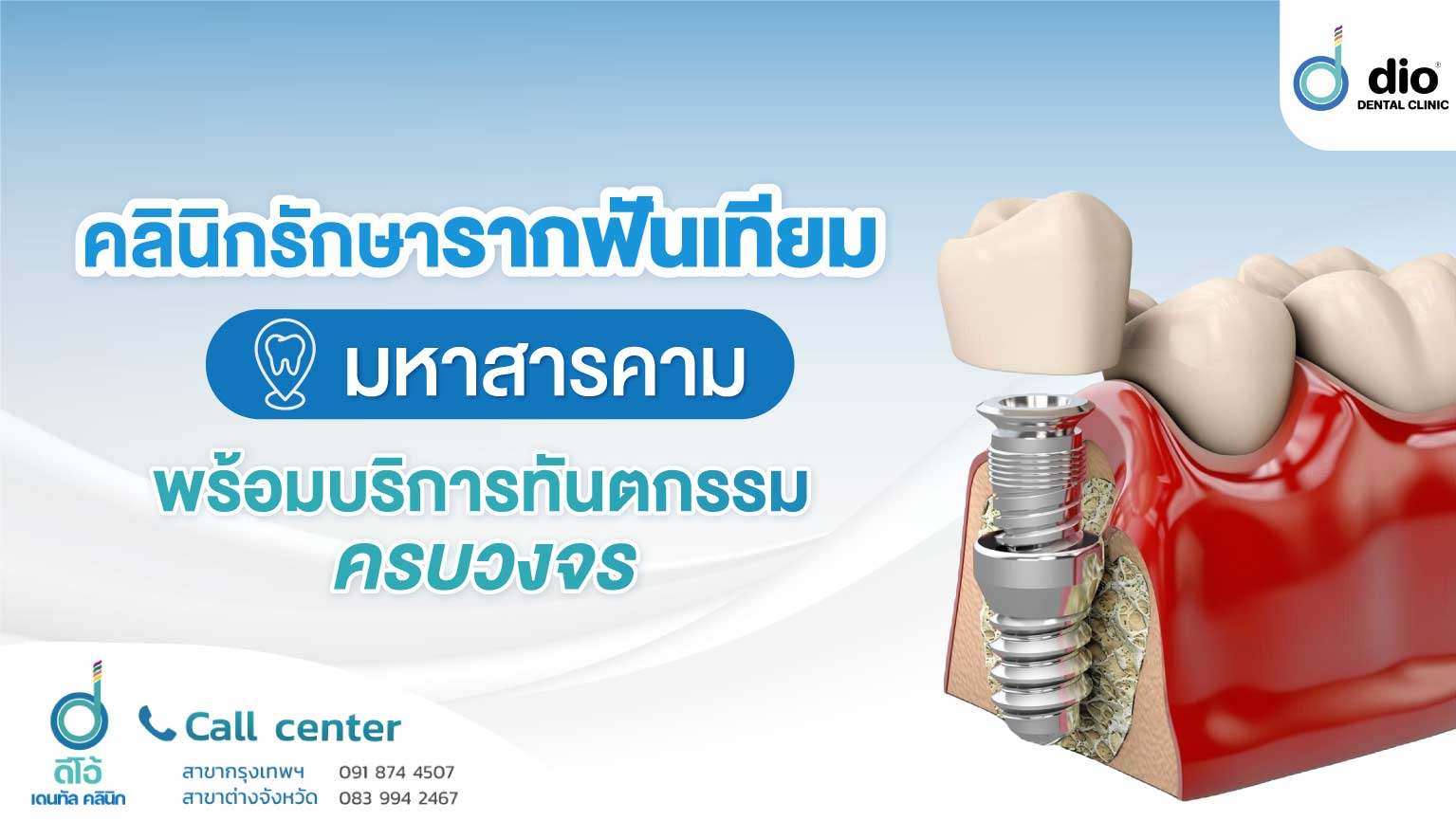 คลินิกรักษารากฟันเทียม มหาสารคาม พร้อมบริการทันตกรรมครบวงจร