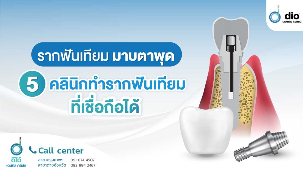 รากฟันเทียม มาบตาพุด