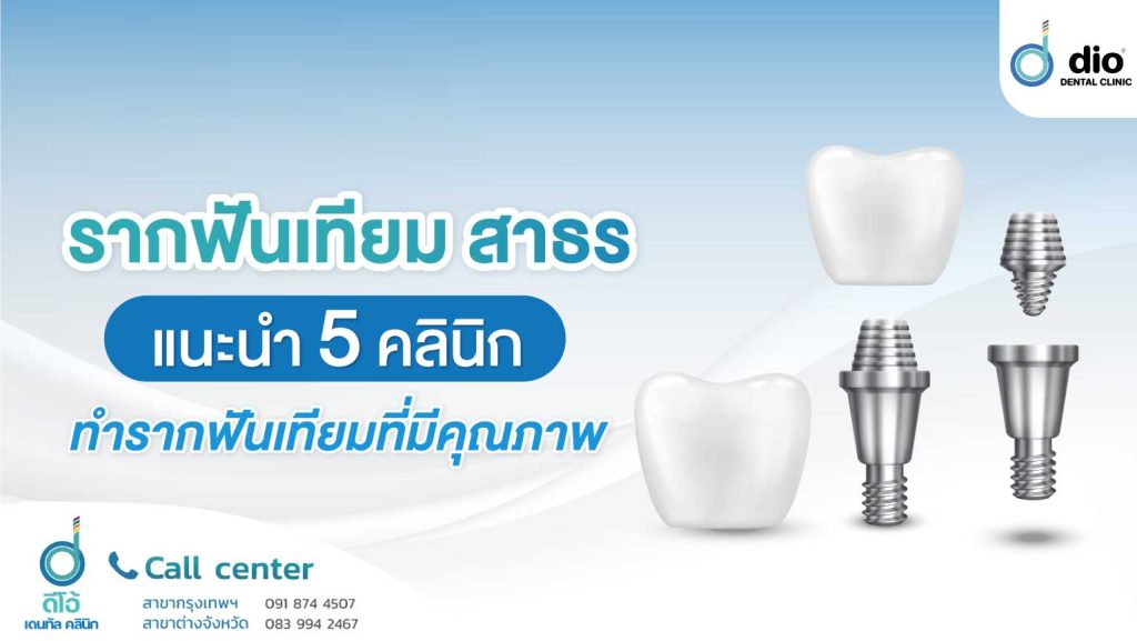 รากฟันเทียม สาธร