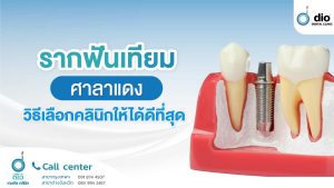 รากฟันเทียม ศาลาแดง