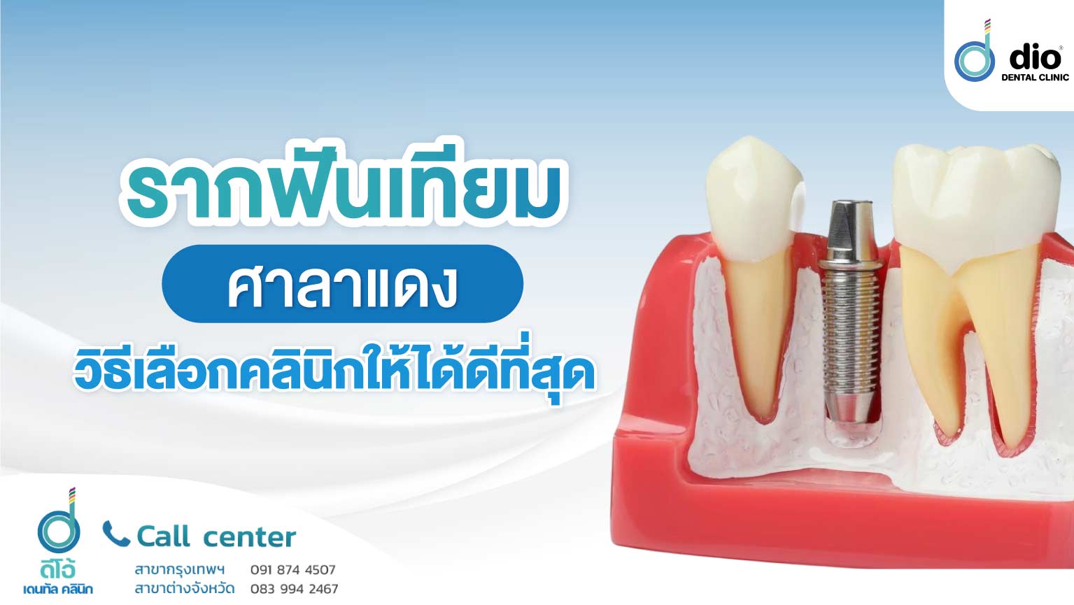 รากฟันเทียม ศาลาแดง