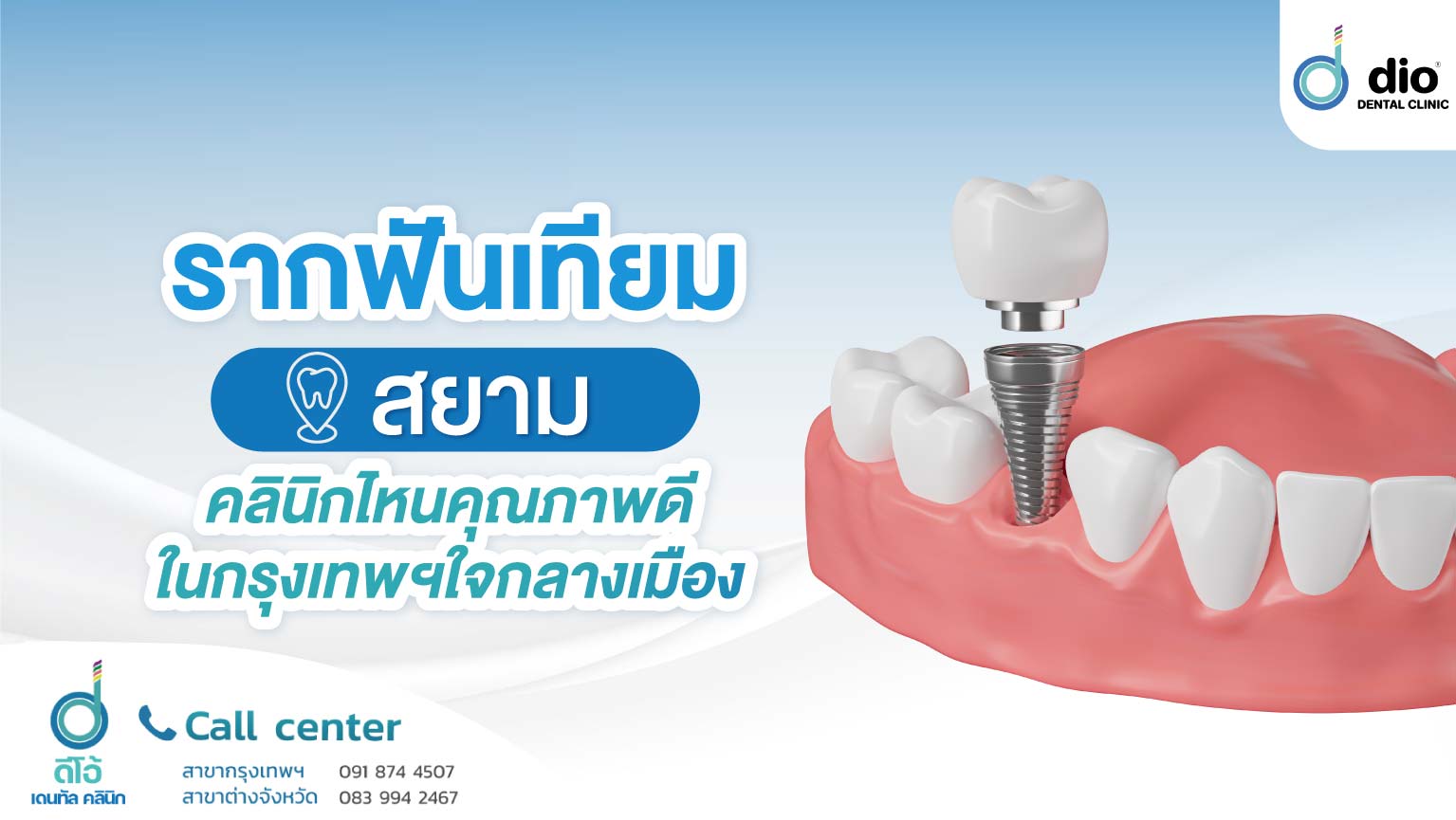 รากฟันเทียม สยาม