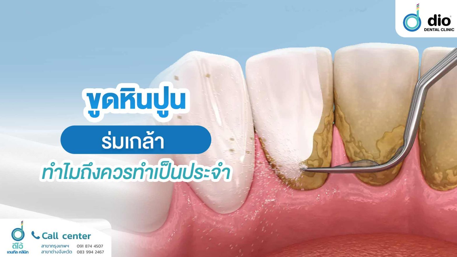 ขูดหินปูน ร่มเกล้า
