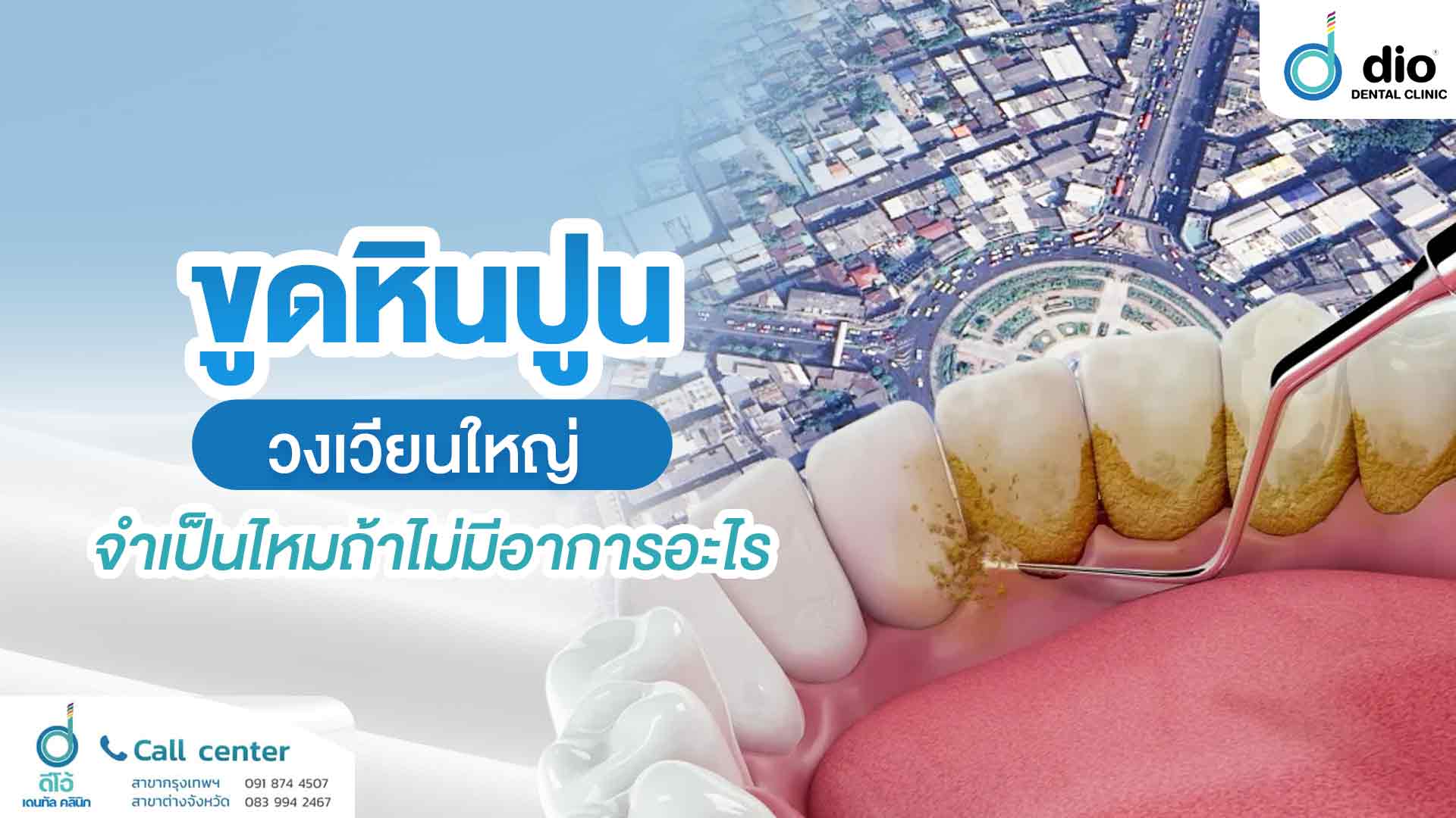 ขูดหินปูน วงเวียนใหญ่