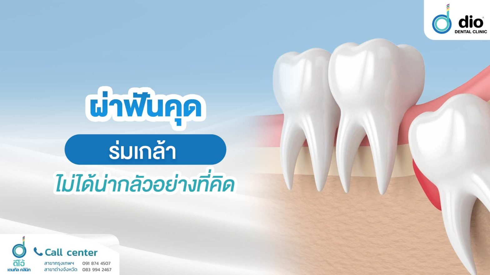 ผ่าฟันคุด ร่มเกล้า