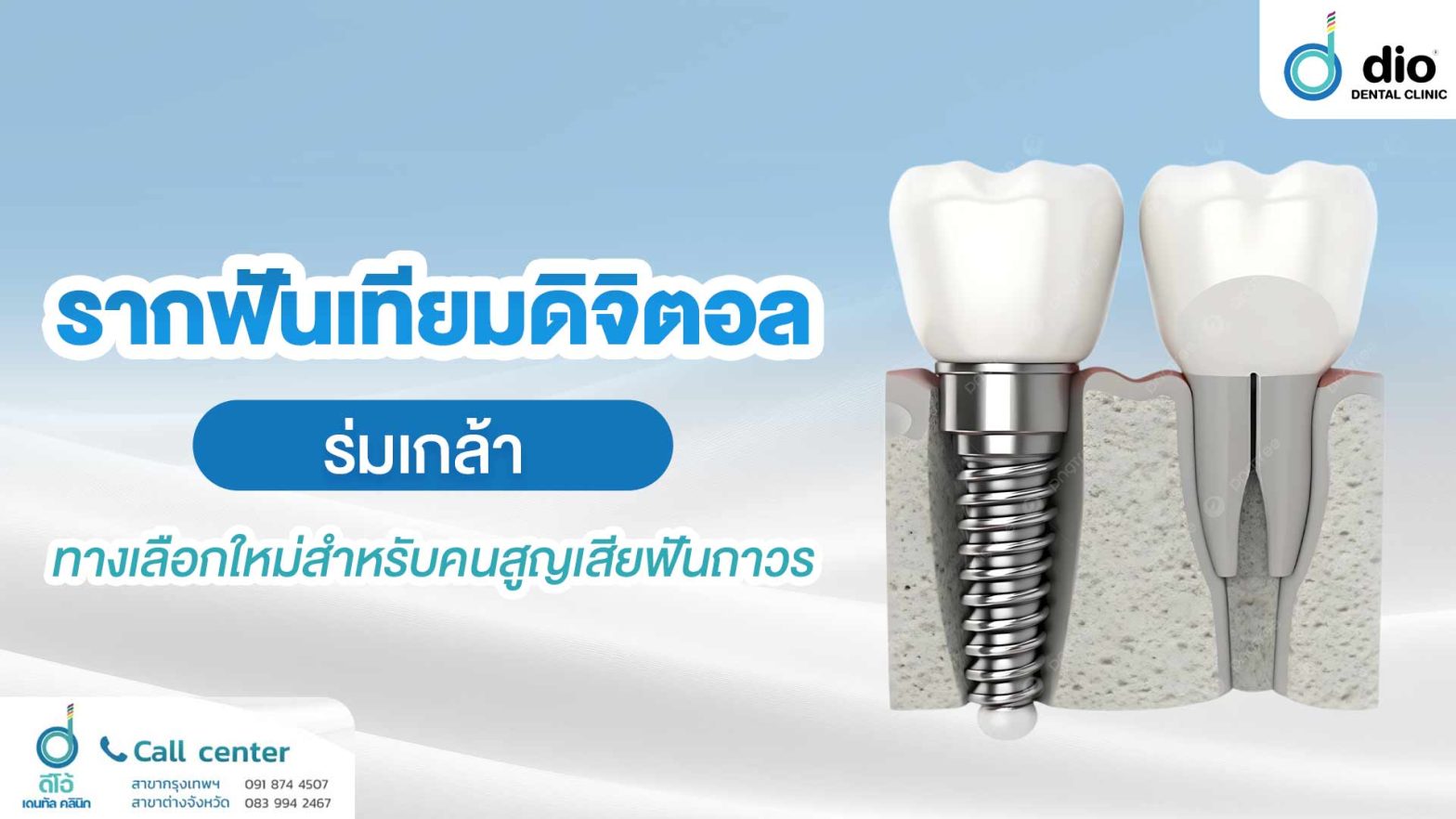 รากฟันเทียมดิจิตอล ร่มเกล้า