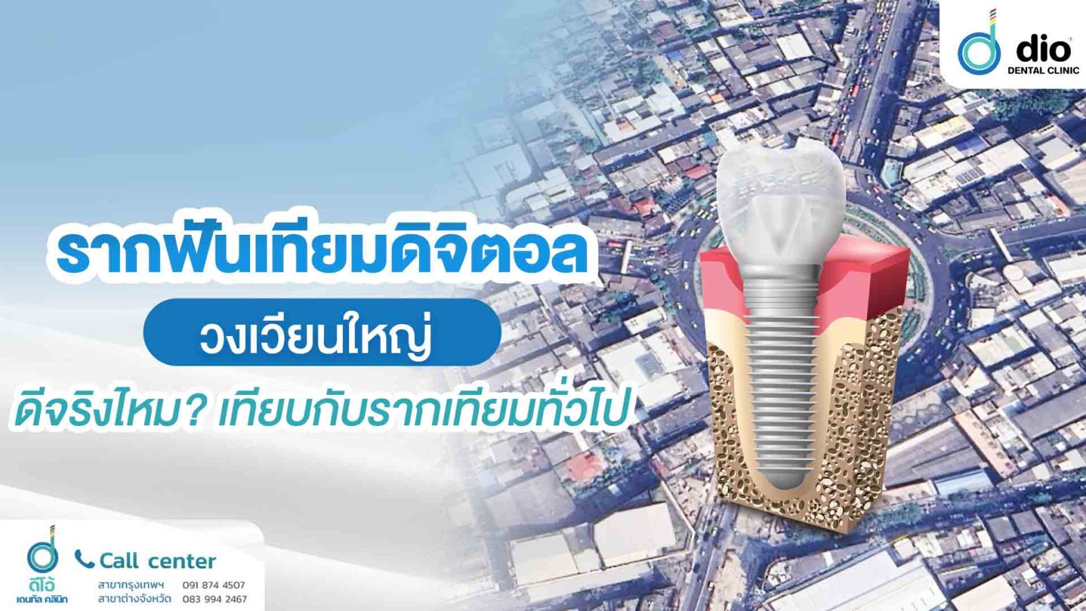 รากฟันเทียมดิจิตอล วงเวียนใหญ่