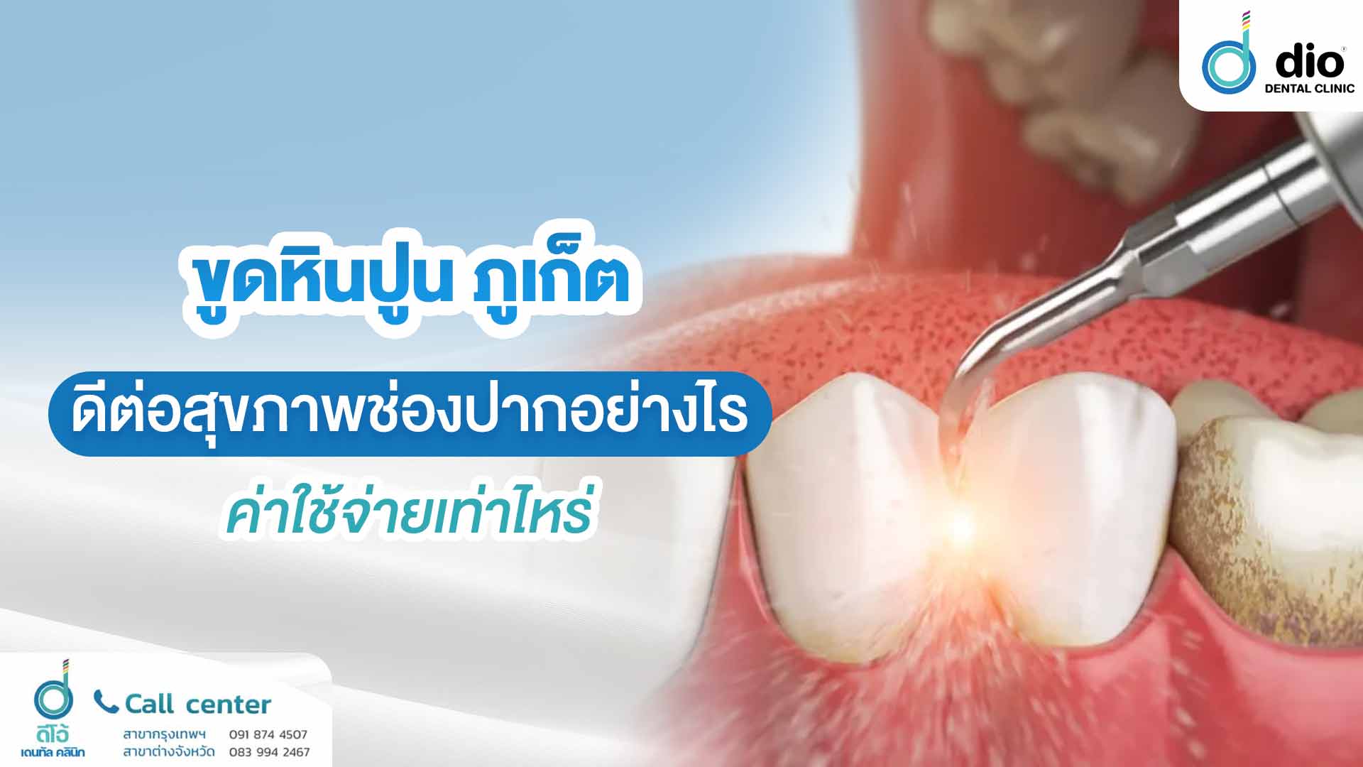 ขูดหินปูน ภูเก็ต ดีต่อสุขภาพช่องปากอย่างไรค่าใช้จ่ายเท่าไหร่