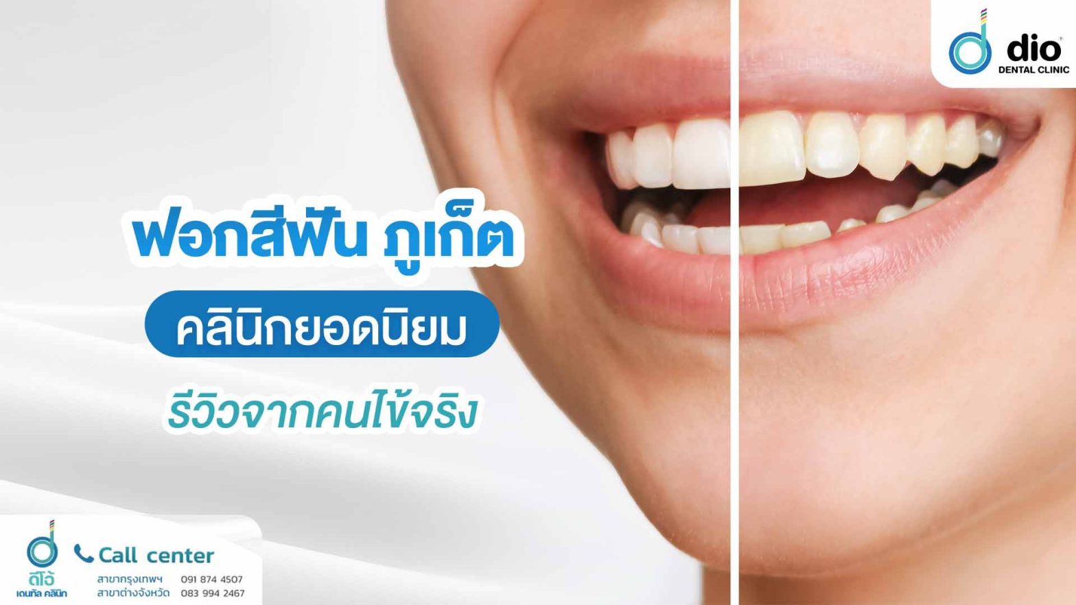 ฟอกสีฟัน ภูเก็ต คลินิกยอด