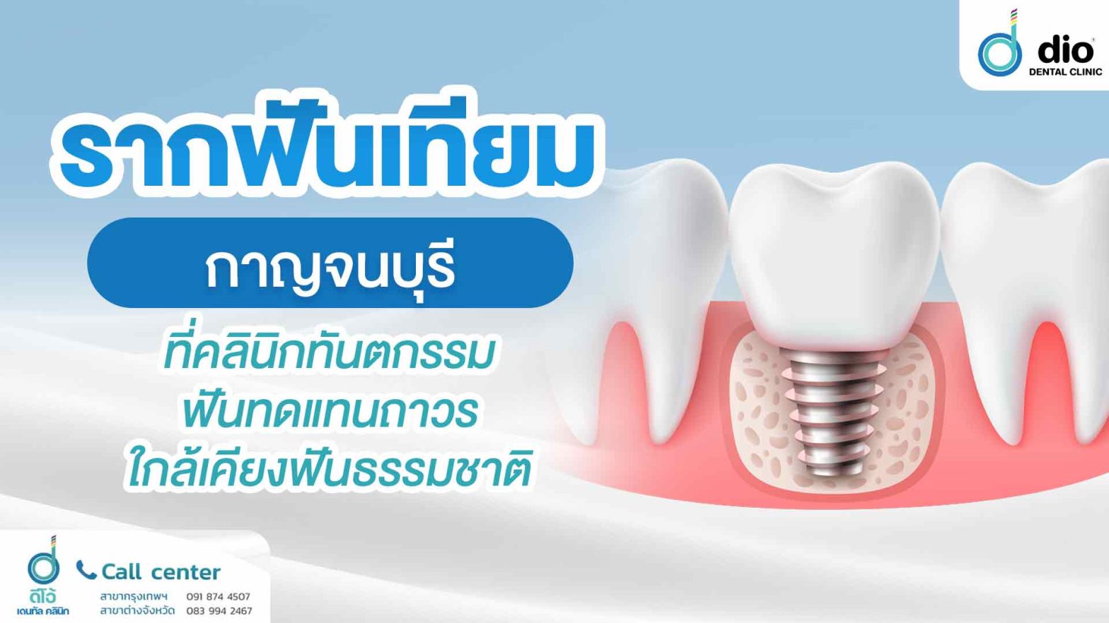 รากฟันเทียม-กาญจนบุรี-ที่คลินิกทันตกรรม-ฟันทดแทนถาวร-ใกล้เคียงฟันธรรมชาติ