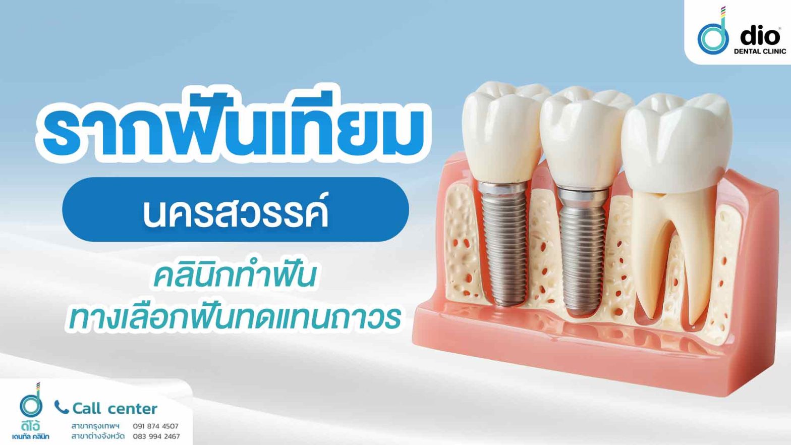 รากฟันเทียม-นครสวรรค์-คลินิกทำฟัน-ทางเลือกฟันทดแทนถาวร