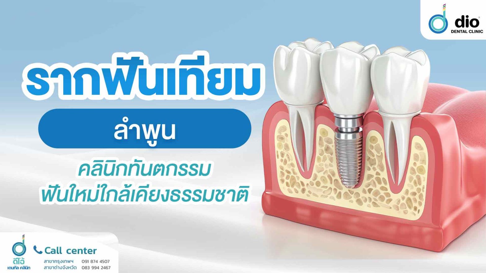 รากฟันเทียม-ลำพูน-คลินิกทันตกรรม-ฟันใหม่ใกล้เคียงธรรมชาติ