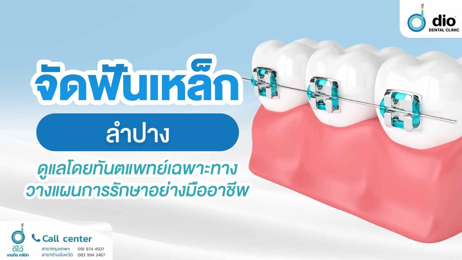จัดฟันเหล็ก-ลำปาง-ดูแลโดยทันตแพทย์เฉพาะทาง-วางแผนการรักษาอย่างมืออาชีพ