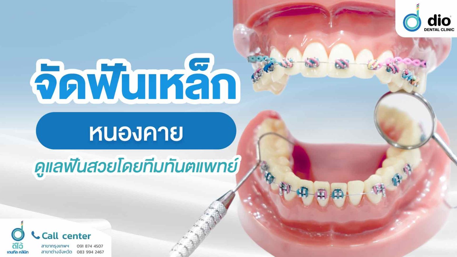 จัดฟันเหล็ก-หนองคาย-ดูแลฟันสวยโดยทีมทันตแพทย์