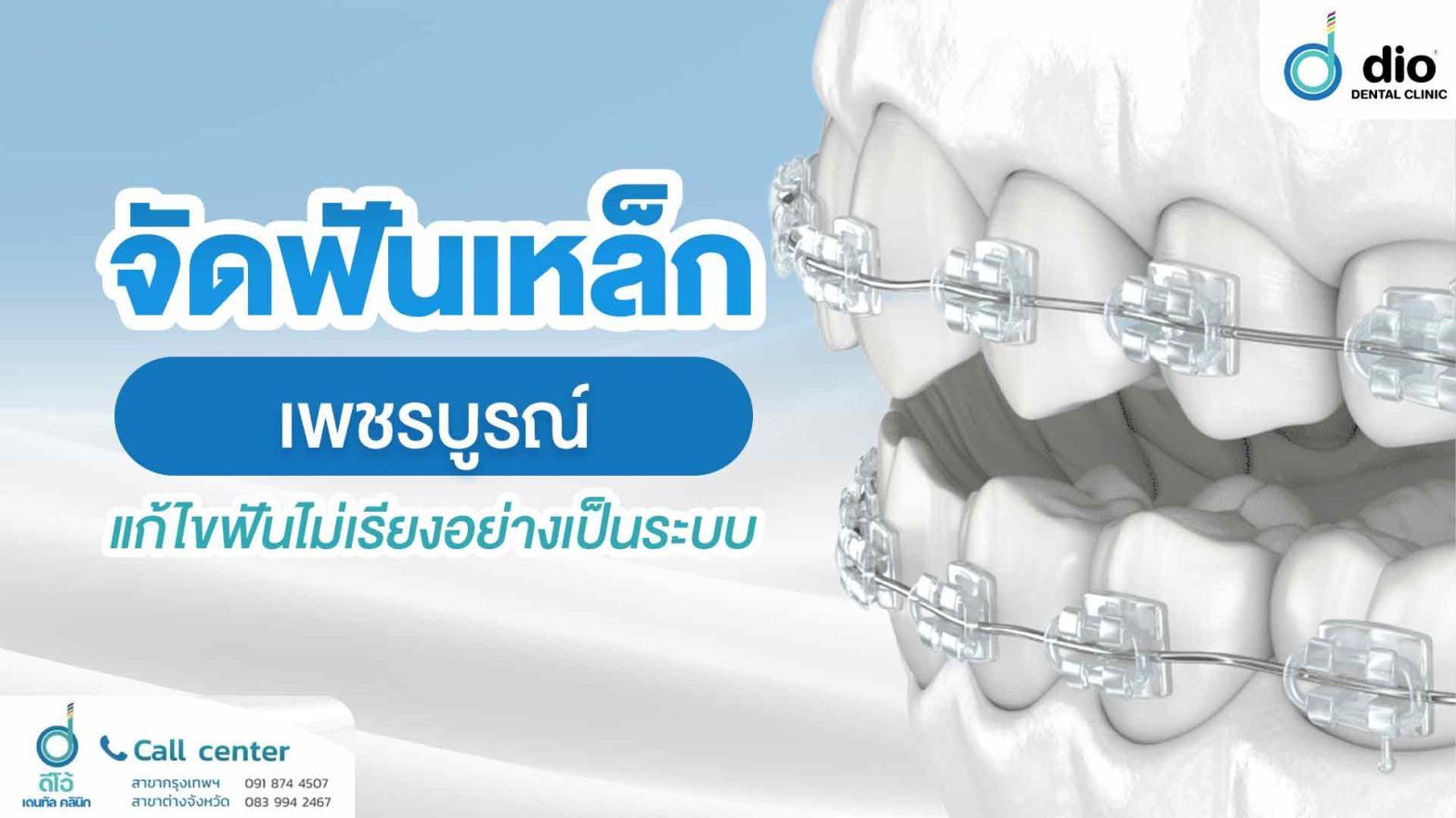 จัดฟันเหล็ก-เพชรบูรณ์-แก้ไขฟันไม่เรียงอย่างเป็นระบบ