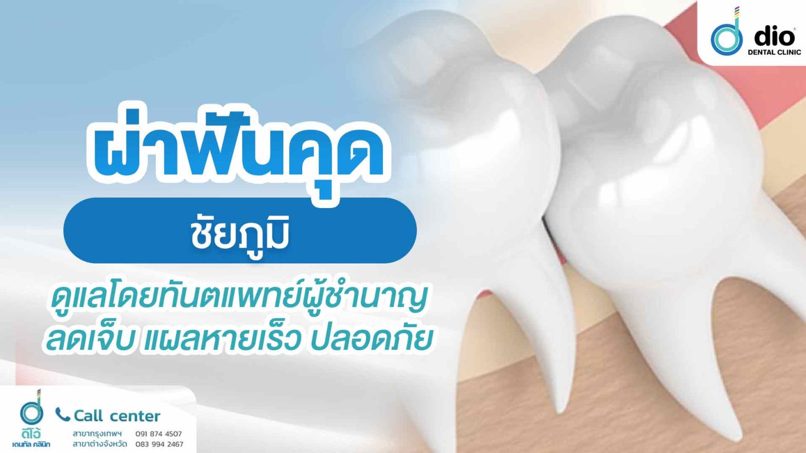 ผ่าฟันคุด-ชัยภูมิ-ดูแลโดยทันตแพทย์ผู้ชำนาญ-ลดเจ็บ-แผลหายเร็ว-ปลอดภัย