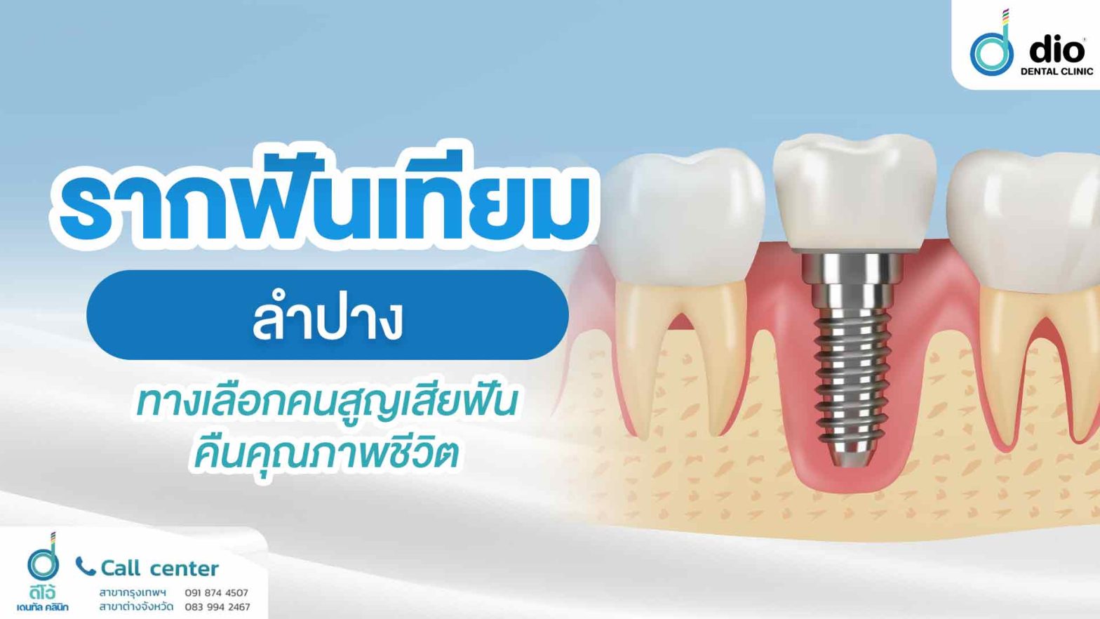 รากฟันเทียม-ลำปาง-ทางเลือกคนสูญเสียฟัน-คืนคุณภาพชีวิต