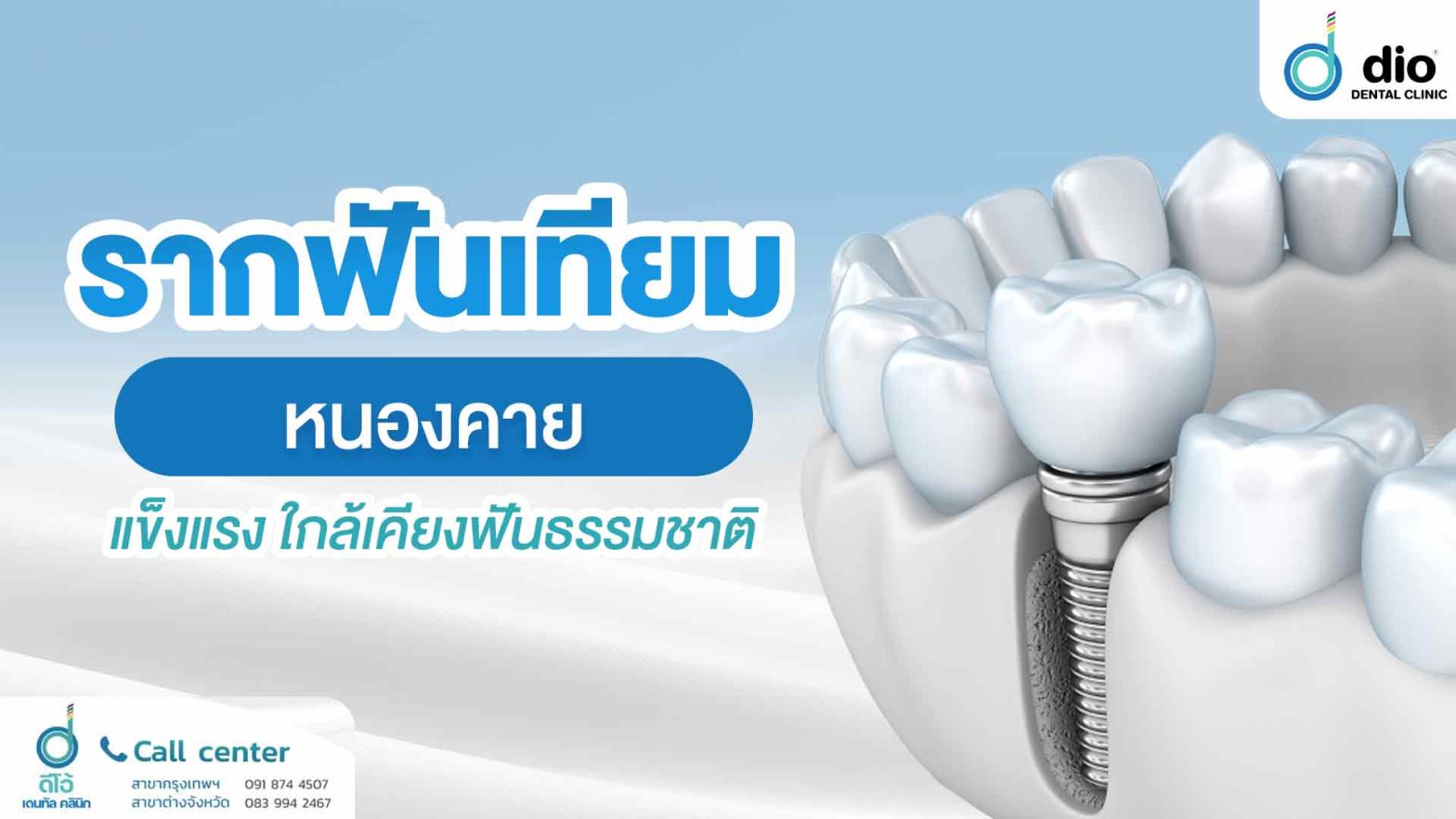 รากฟันเทียม-หนองคาย-แข็งแรง-ใกล้เคียงฟันธรรมชาติ