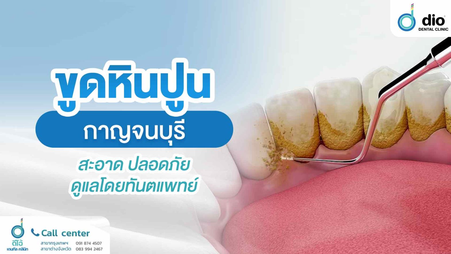 ขูดหินปูน-กาญจนบุรี-สะอาด-ปลอดภัย-ดูแลโดยทันตแพทย์