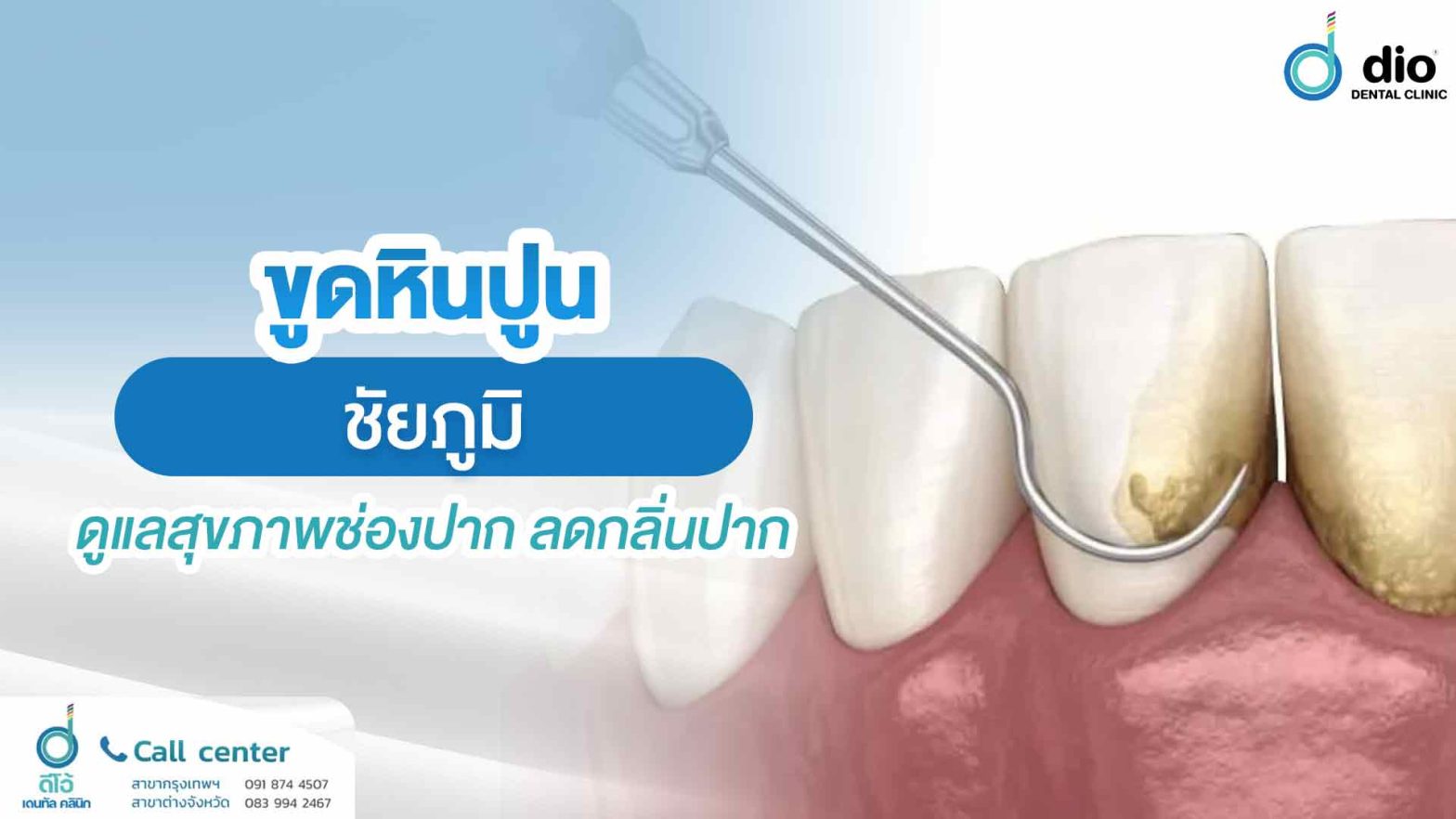 ขูดหินปูน-ชัยภูมิ-ดูแลสุขภาพช่องปาก-ลดกลิ่นปาก