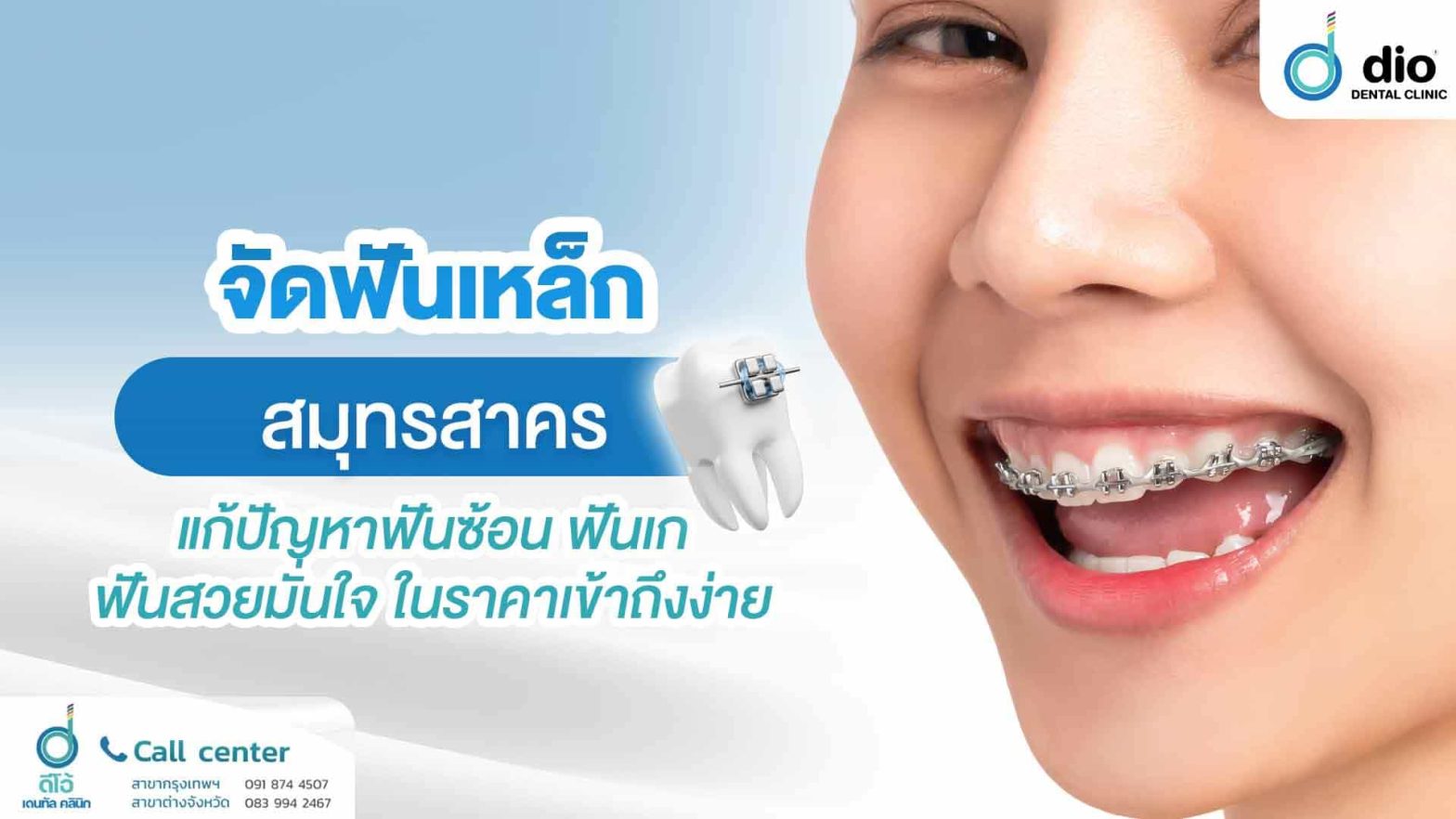 จัดฟันเหล็ก-สมุทรสาคร-แก้ปัญหาฟันซ้อน-ฟันเก-ฟันสวยมั่นใจ-ในราคาเข้าถึงง่าย
