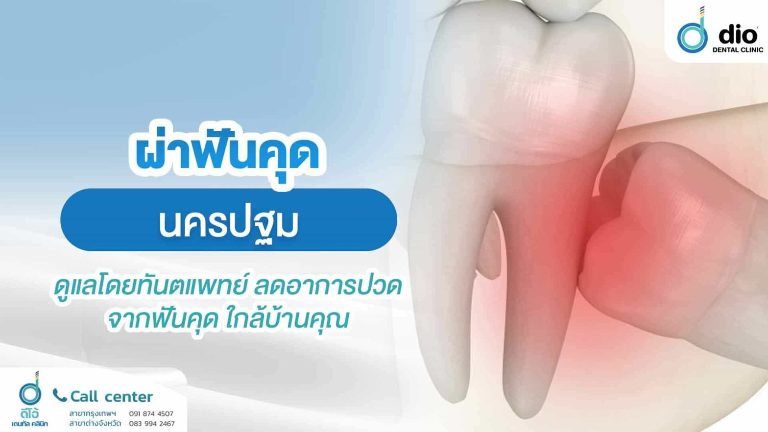 ผ่าฟันคุด-นครปฐม-ดูแลโดยทันตแพทย์-ลดอาการปวดจากฟันคุด-ใกล้บ้านคุณ